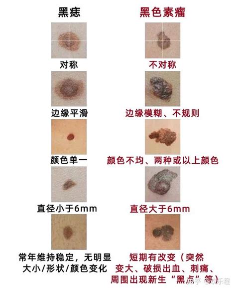 小黑痣|这样的黑痣竟是“黑色素瘤”！医生：超过这个尺寸的黑。